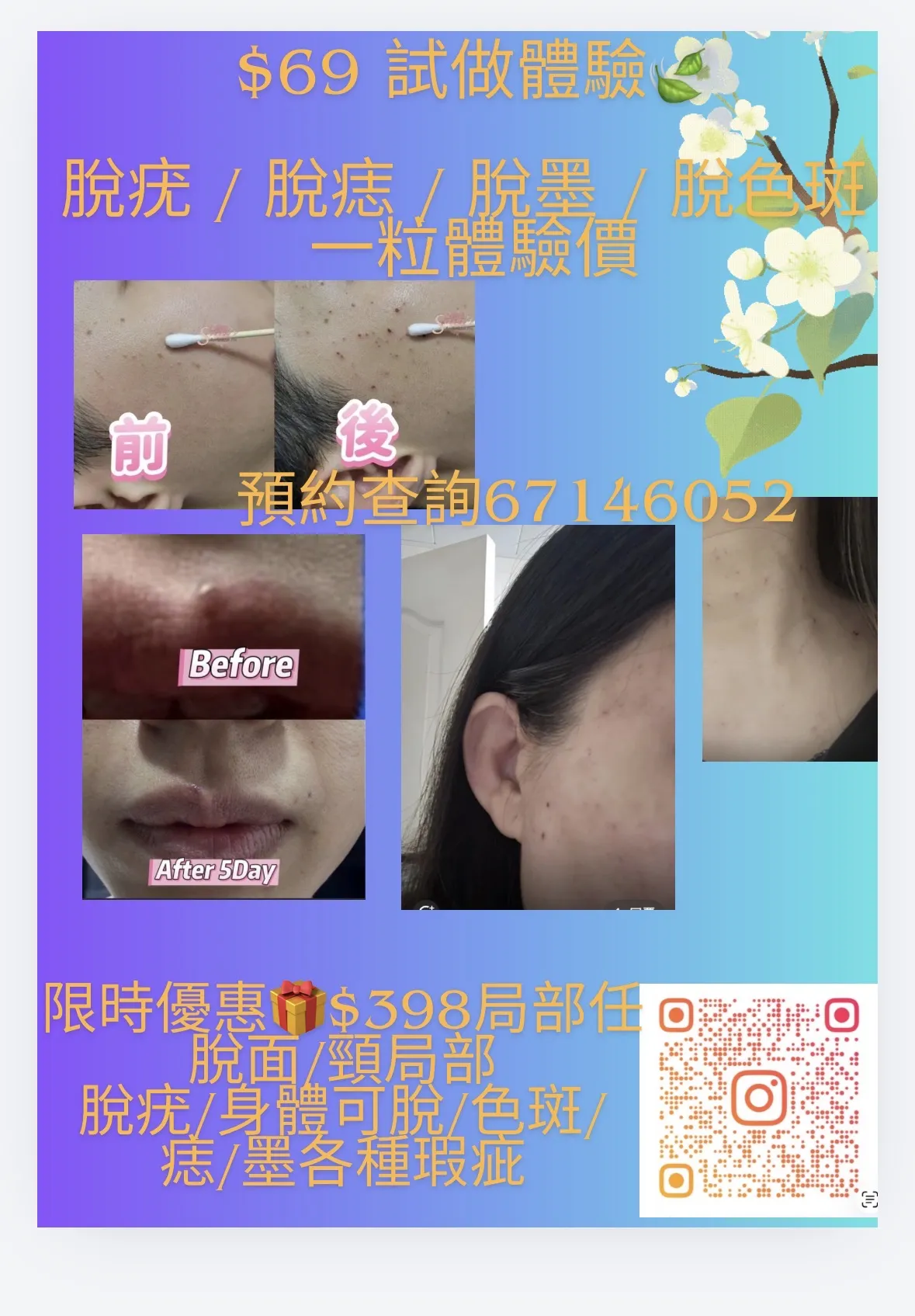 $69限時優惠體驗🎁脫疣 / 脫墨 / 脫痣 / 脫色斑🍃 🔥限時升級優惠 $398局部面/頸部任脫瑕疵及🎁免費送15分鐘
