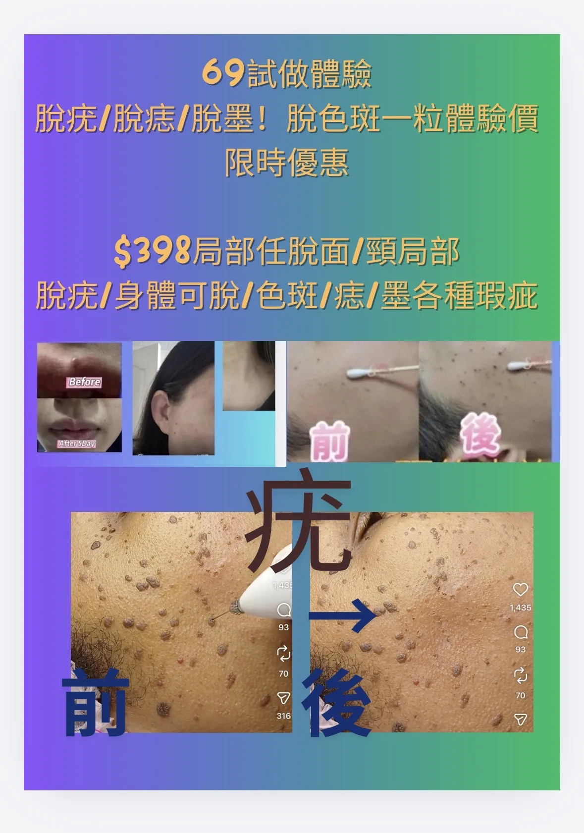 $69限時優惠體驗🎁脫疣 / 脫墨 / 脫痣 / 脫色斑🍃  墨、痣、色斑、肉粒、紅痣 全身各部位皮膚瑕疵都得！