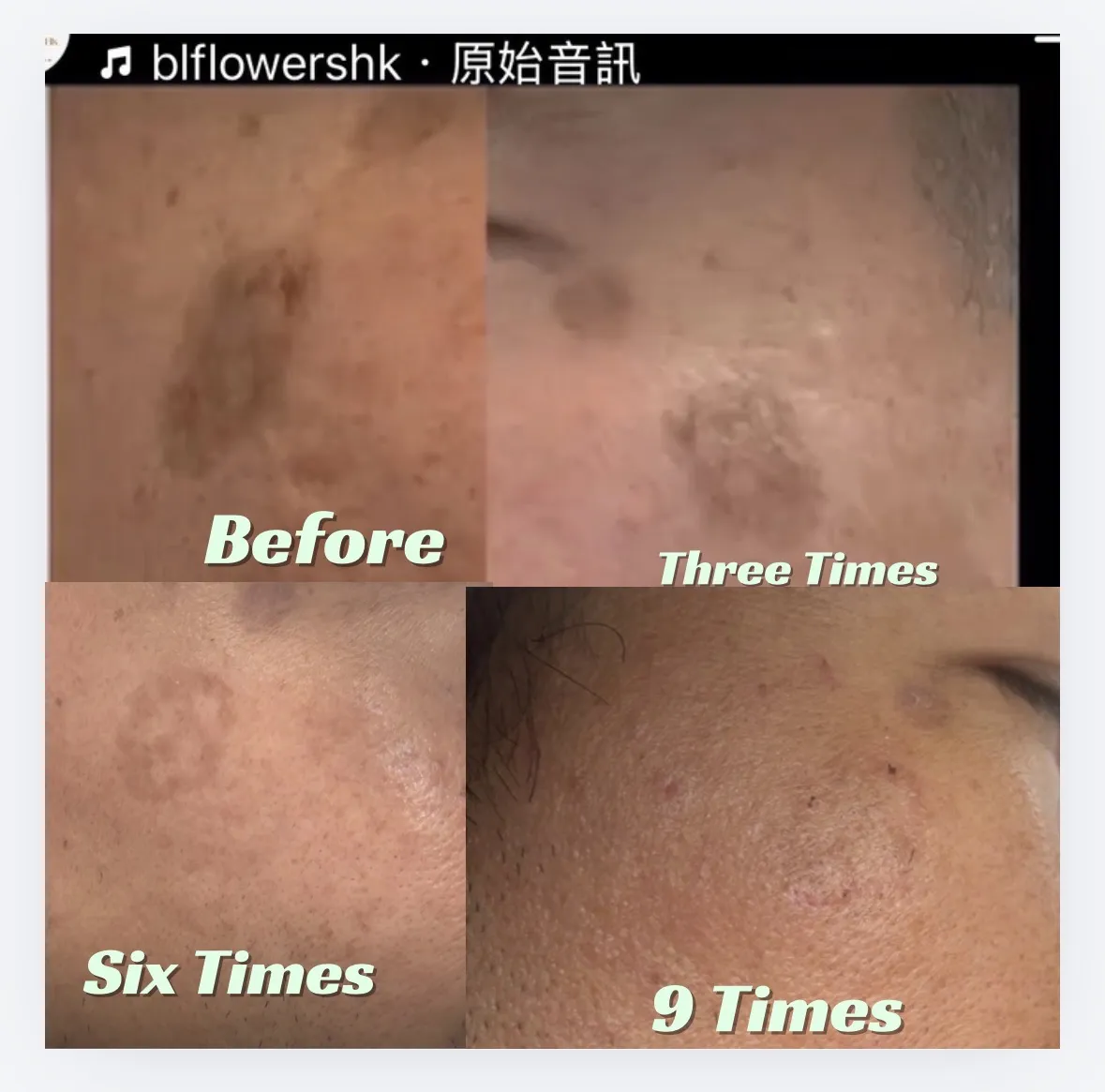 觀塘單次收費🔥$498｜無創導入三文魚PDRN精華修復護理 限時優惠🎁激光美白嫩膚療程|鈦塑局部緊緻塑形療程